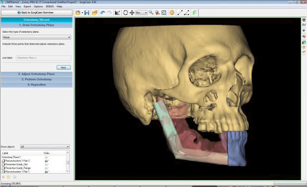 Materialise ProPlan CMF 3.0.1